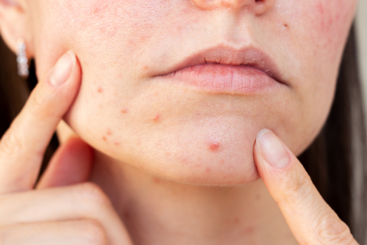 How is hormonal acne treated?