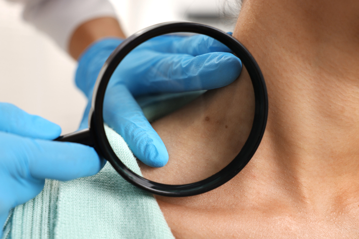 What to expect before, during, and after a skin biopsy