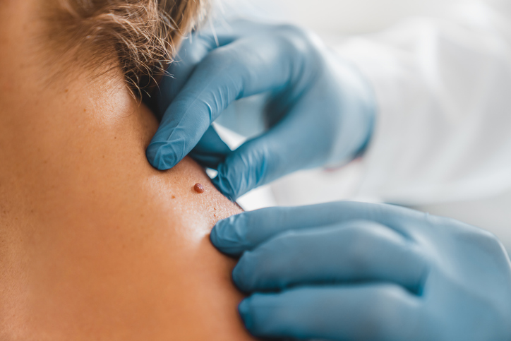 What does a cancerous mole look like & when should you see a dermatologist?